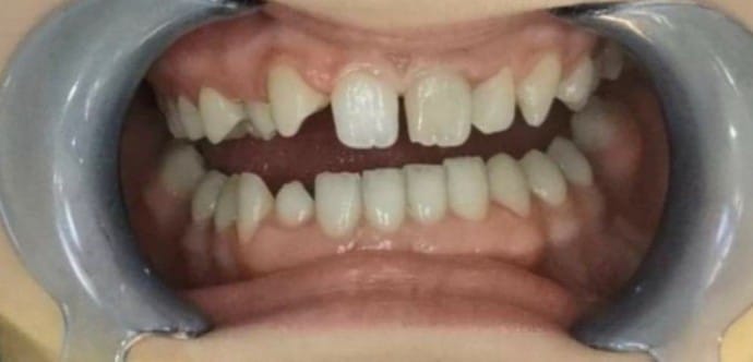 Celokeramické korunky E-Max Celokeramické korunky E-Max