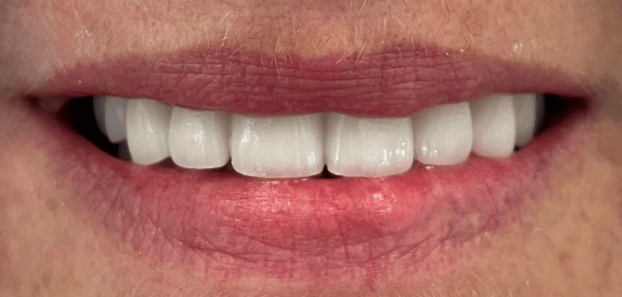 Prirodzený úsmev Prirodzený úsmev