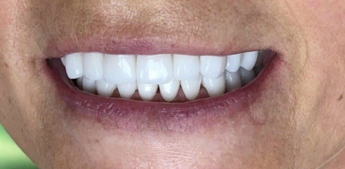 20 zirk&oacute;nov&yacute;ch koruniek bleach white