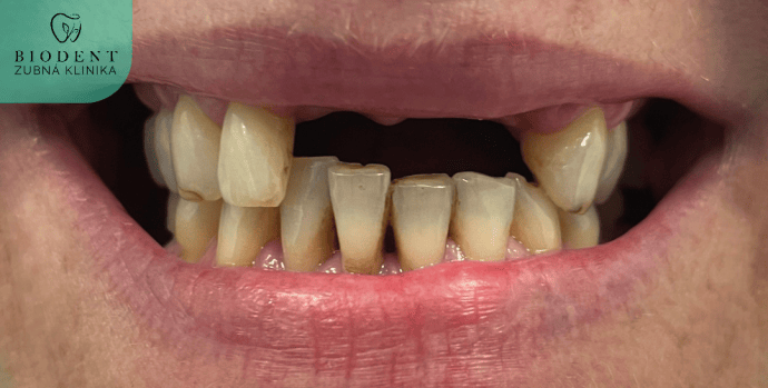 Prirodzený úsmev Prirodzený úsmev