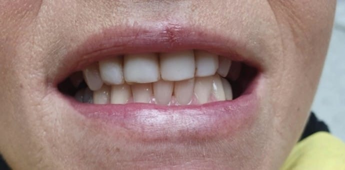 20 zirkónových koruniek bleach white 20 zirkónových koruniek bleach white