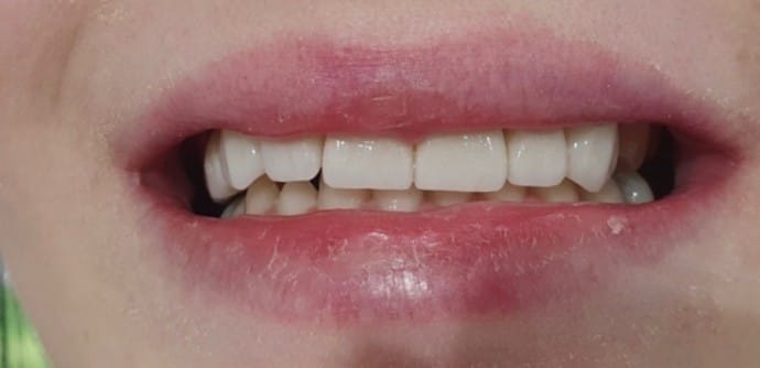 Celokeramické korunky E-Max Celokeramické korunky E-Max