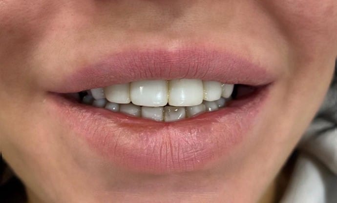 Keramické fazety B1 Keramické fazety B1