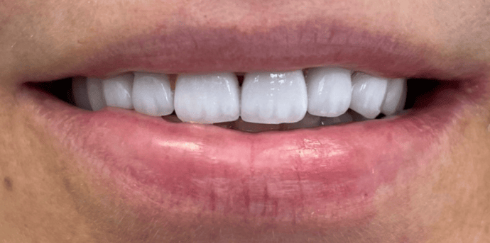 Zirkónové korunky v odtieni BleachWhite Zirkónové korunky v odtieni BleachWhite