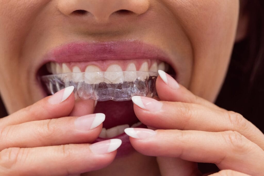 Neviditeľné zubné strojčeky Invisalign