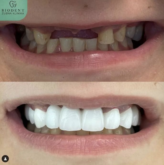 Keramické korunky 3 Keramické korunky