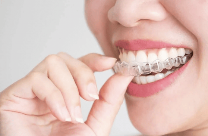 Neviditeľné zubné strojčeky Invisalign Neviditeľné zubné strojčeky Invisalign