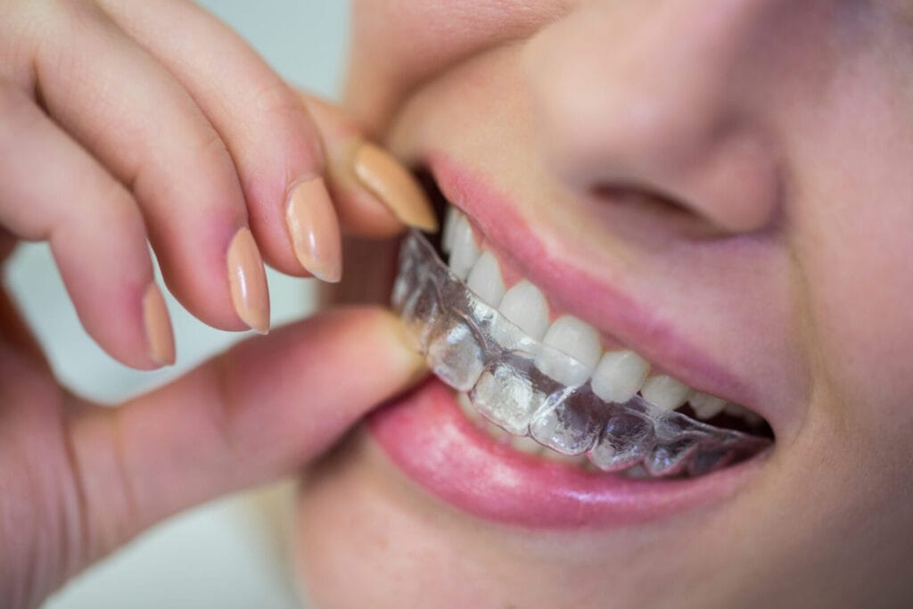 Neviditeľné zubné strojčeky Invisalign