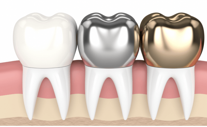 Zubné korunky 2 Zubné korunky