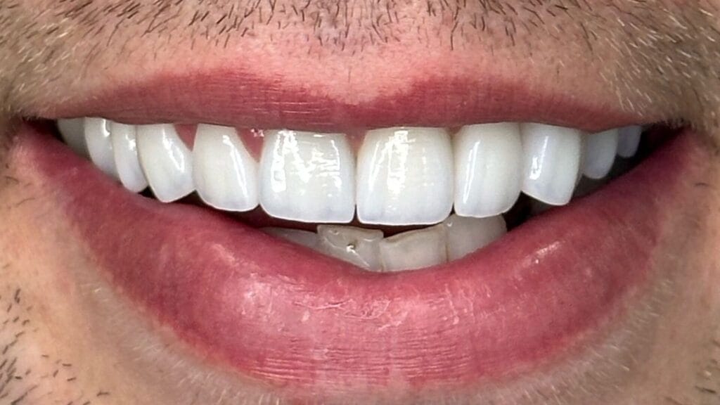 Zirkonove korunky za par dni